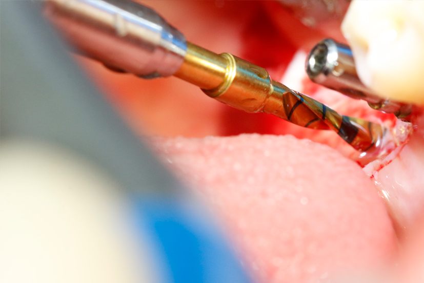 Imagen de la realizaci&oacute;n de un tratamiento de implante dental en curso de implantolog&iacute;a